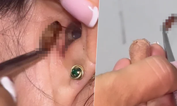 Baş ağrısı şikayetiyle doktora giden kadının kulağından hamam böceği çıktı