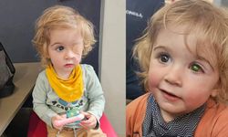2 yaşındaki çocuk öpücük yüzünden kör oldu!