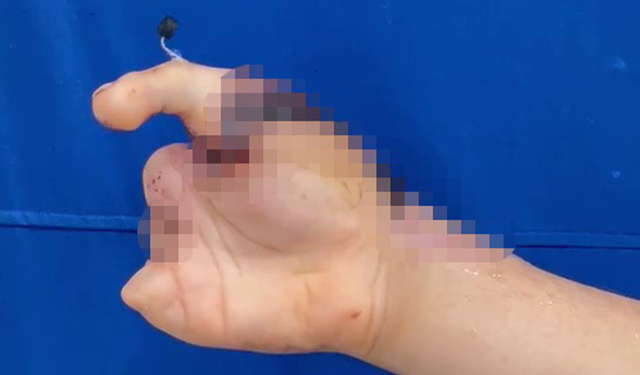 Parmaklarını kıyma makinesine kaptıran 13 yaşındaki çocuğa ayağından nakil