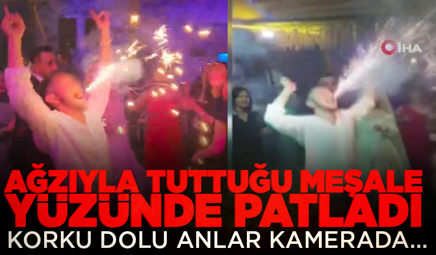 Düğünde ağzıyla tuttuğu meşale yüzünde patladı