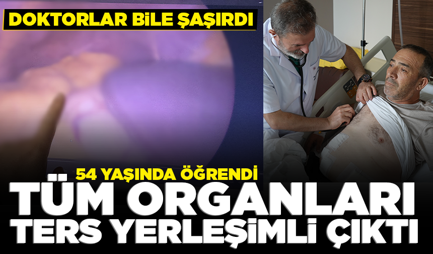 54 yaşında öğrendi! Tüm organları ters yerleşimli çıktı