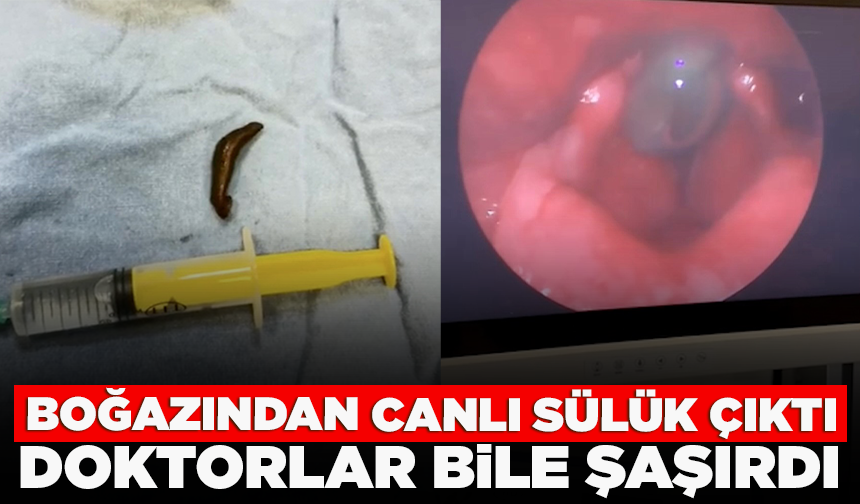 Vatandaşın boğazından çıkan canlı sülük doktorları bile şaşırttı